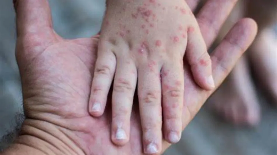 România, pe primul loc în UE la cazurile de rujeolă! Efectul dramatic al prăbușirii ratei de vaccinare în rândul copiilor