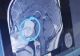 Persoanele cu această grupă de sânge au cel mai mare risc de accident vascular cerebral